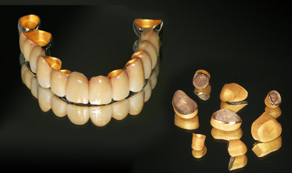 apex dentallabor leistung Friktionsvergoldung