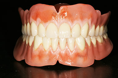 herausnehmbarer Zahnersatz - Vollprothesen